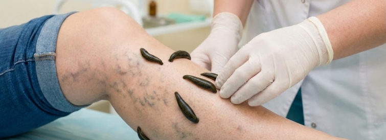 Лечение варикоза пиявками