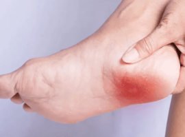 Лечение пяточной шпоры методом УВТ