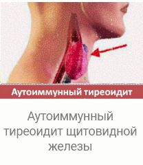 Аутоиммунный тиреоидит щитовидной железы